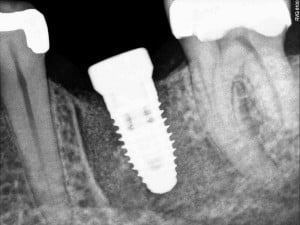 Top Dental Implants Indianapolis